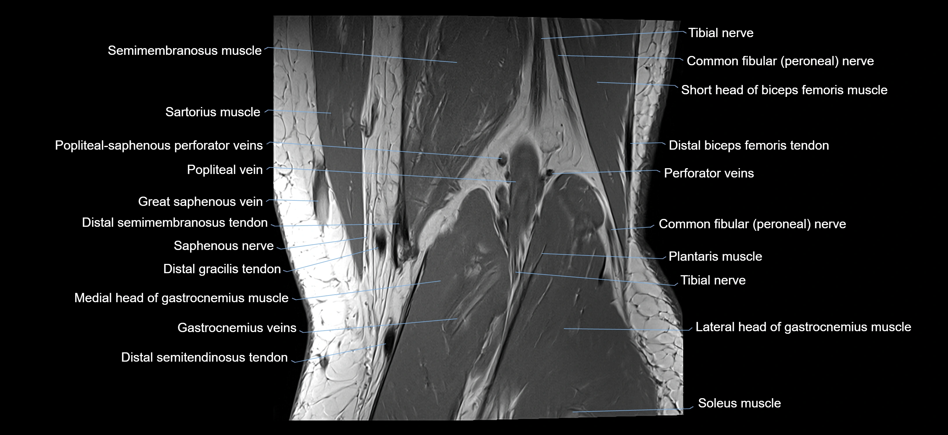 MRI knee coronal cross sectional anatomy labelled 3T radiology  image-04001-00035.webp